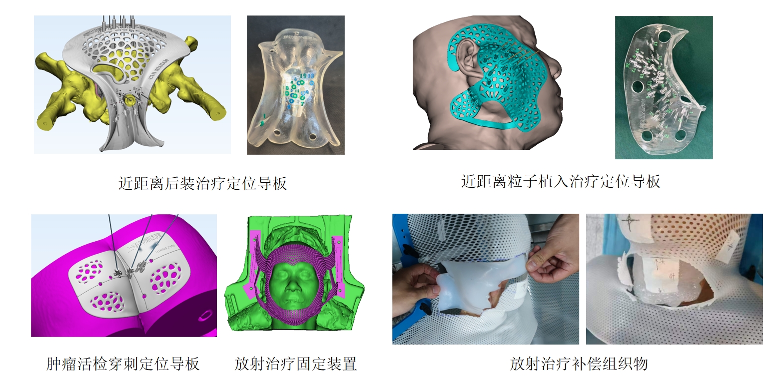 数字化放射治疗展示图